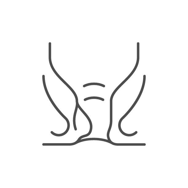 Fistula